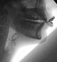 Human jaw in motion